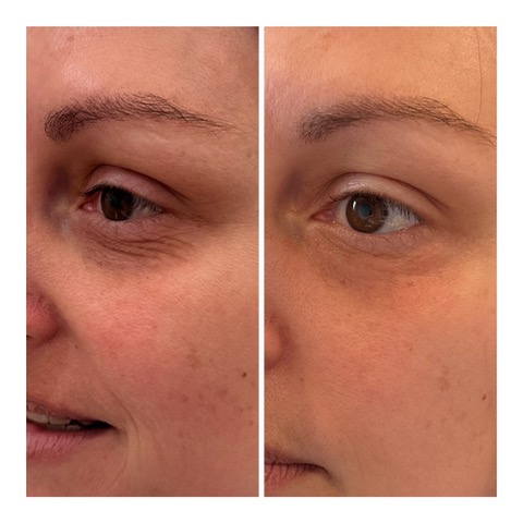 CoolPeel Before & After Image