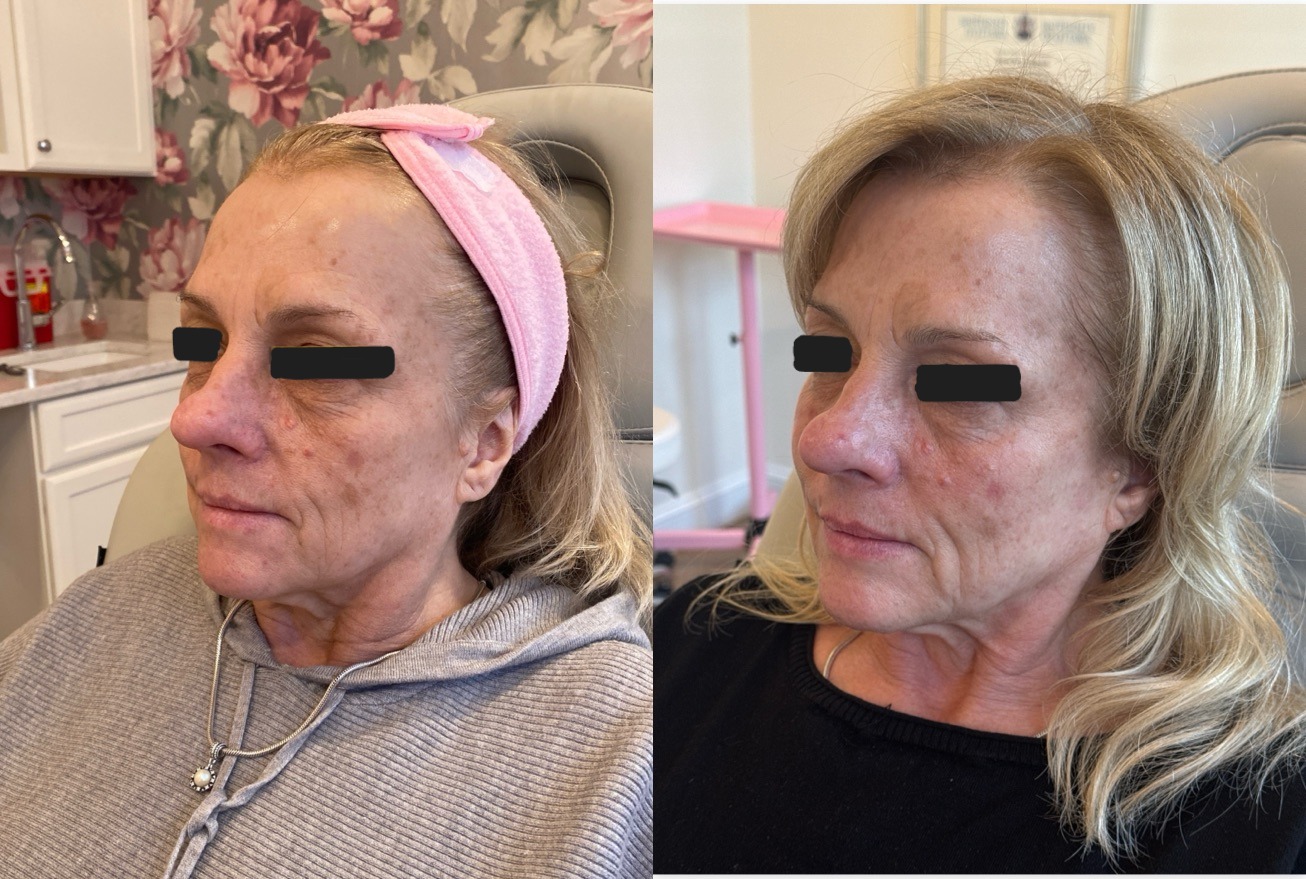 CoolPeel Before & After Image