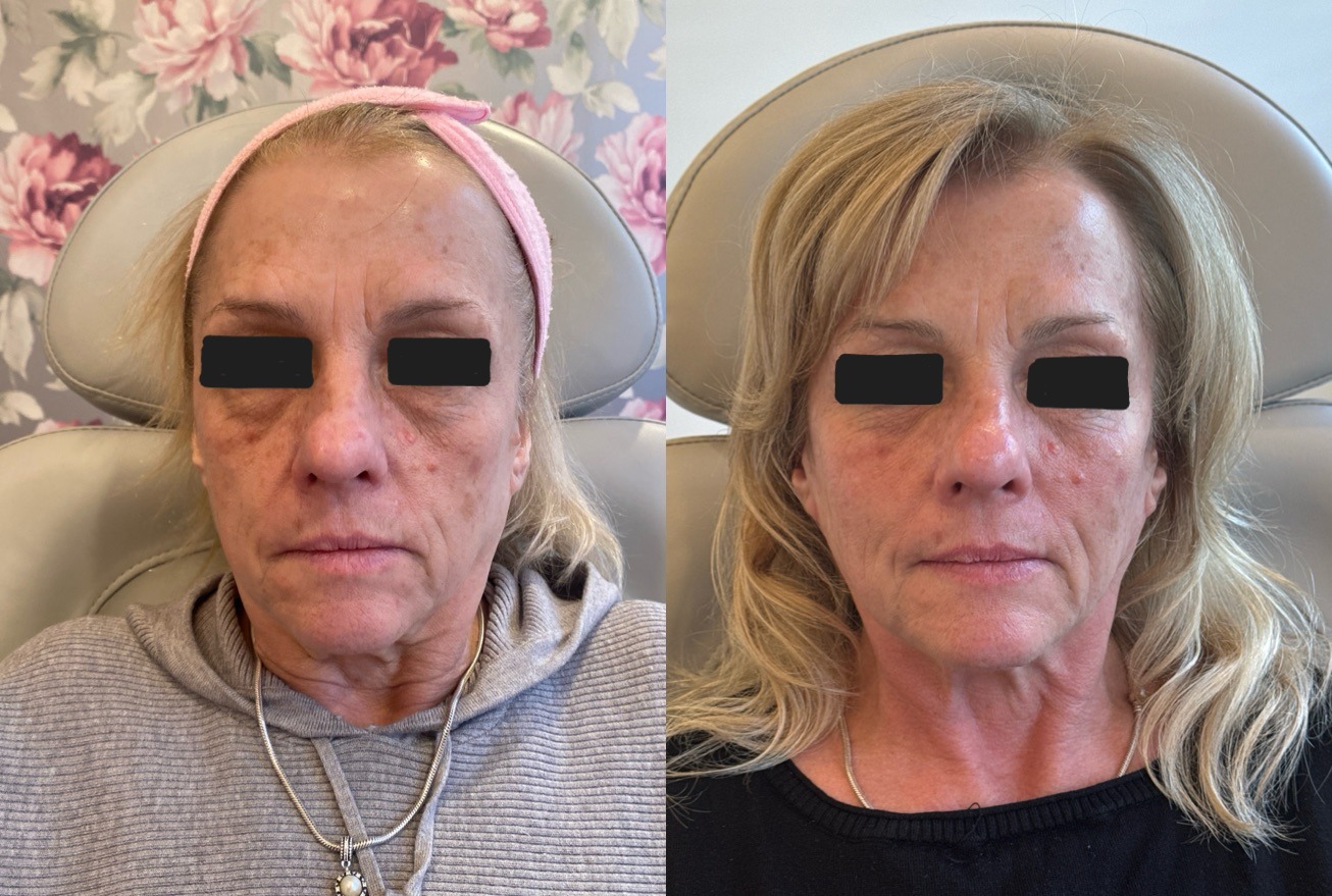 CoolPeel Before & After Image