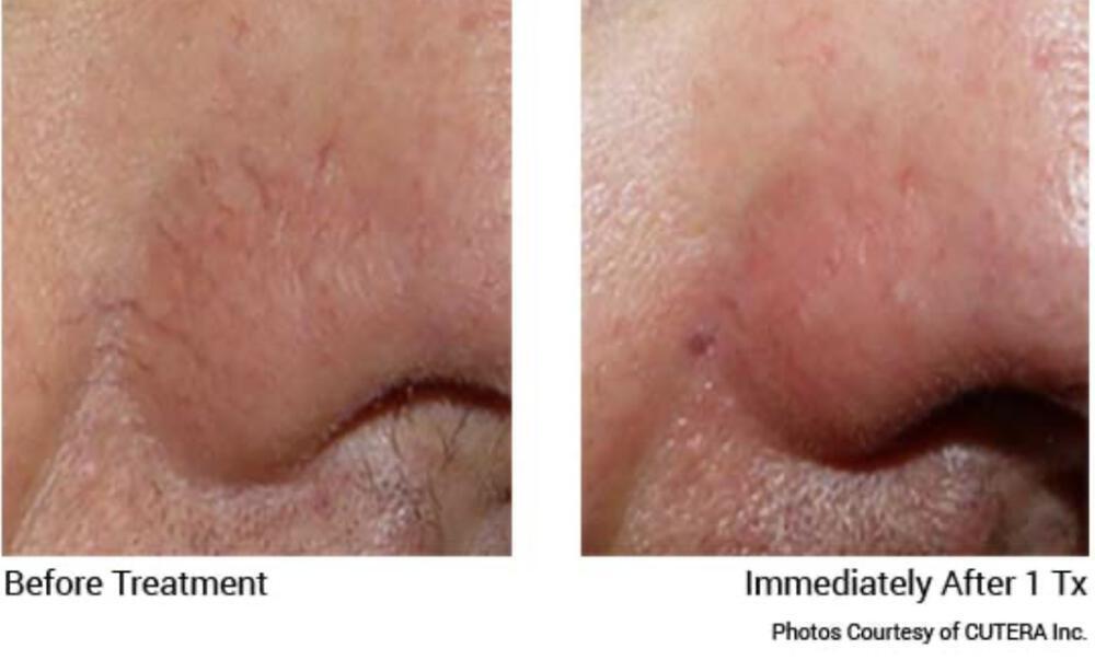 IPL Facial Before & After Image