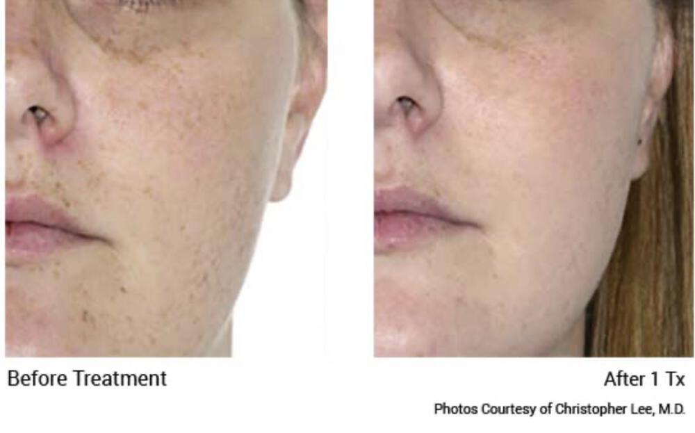 IPL Limelight Facial Before & After Image