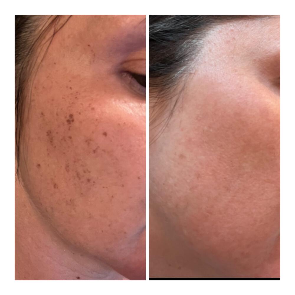 IPL Limelight Facial Before & After Image