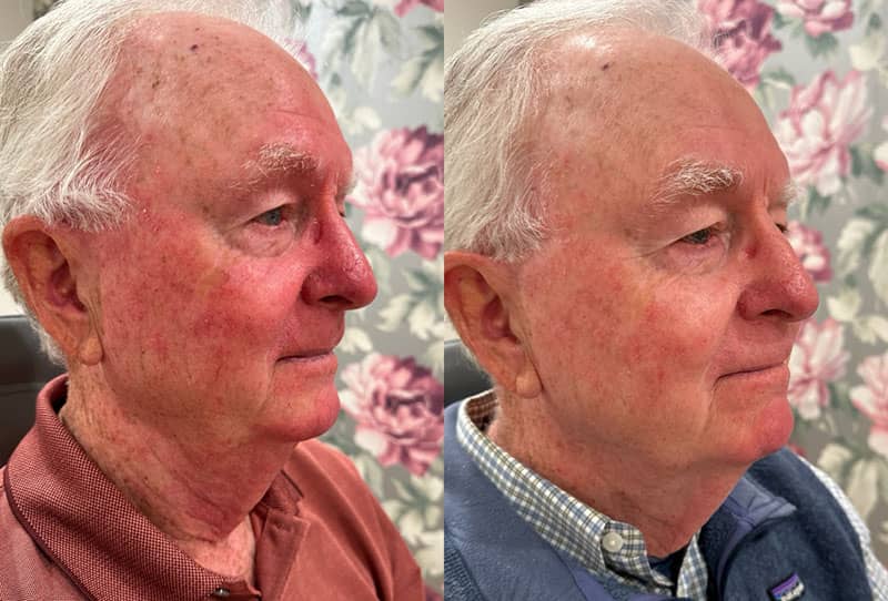 IPL Facial Before & After Image