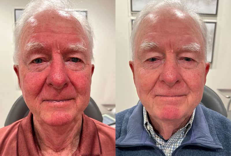 IPL Facial Before & After Image