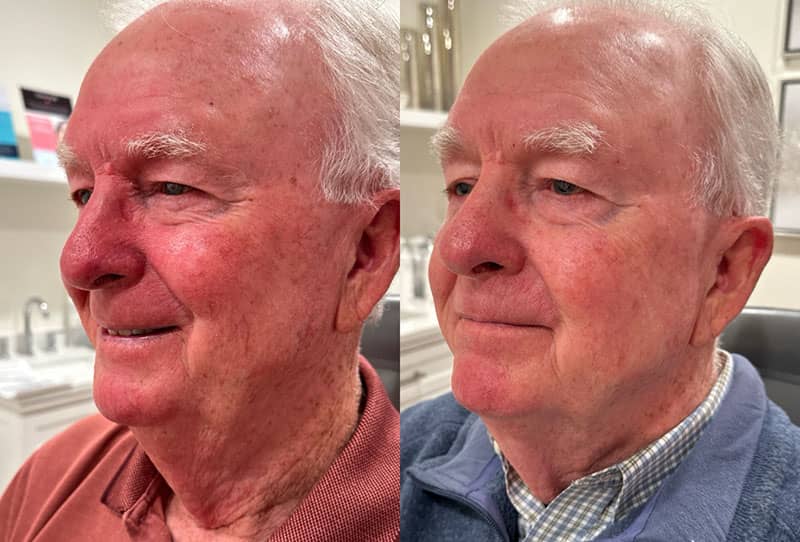 IPL Facial Before & After Image