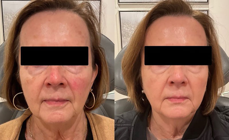 IPL Facial Before & After Image