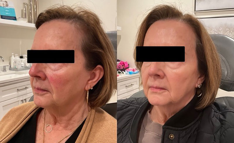 IPL Facial Before & After Image