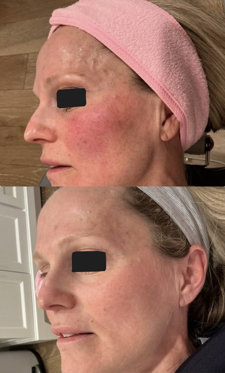 IPL Facial Before & After Image