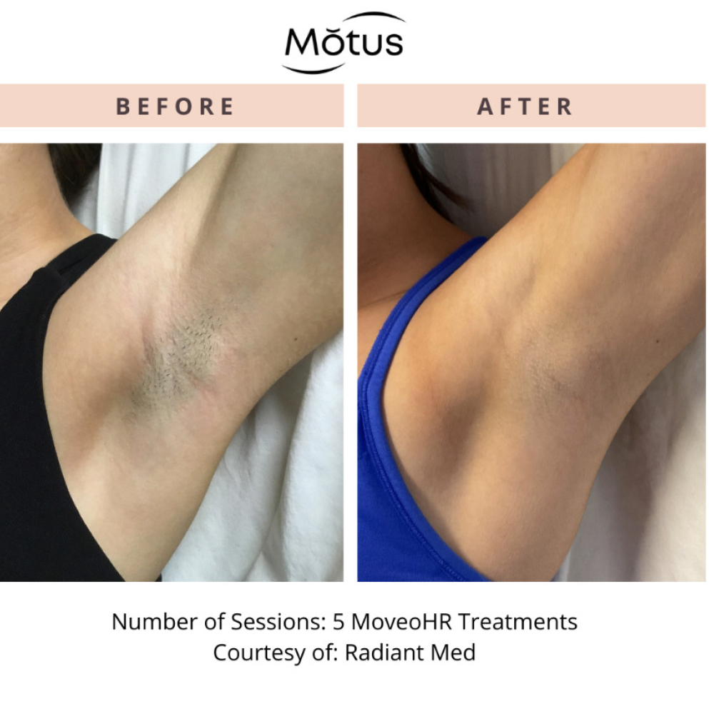 Laser Hair Removal Before & After Image