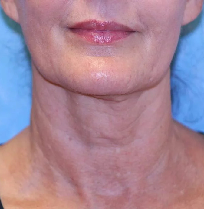 Sofwave Treatment Before & After Image