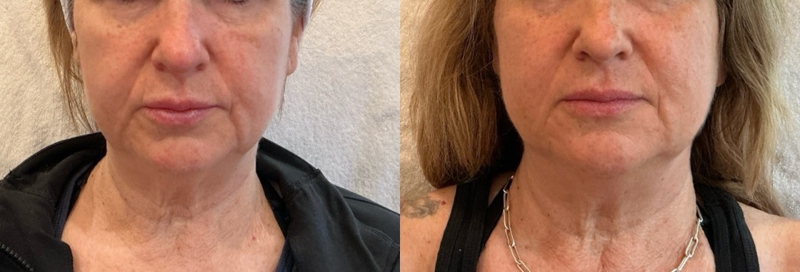 Sofwave Treatment Before & After Image