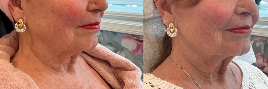 Sofwave Treatment Before & After Image