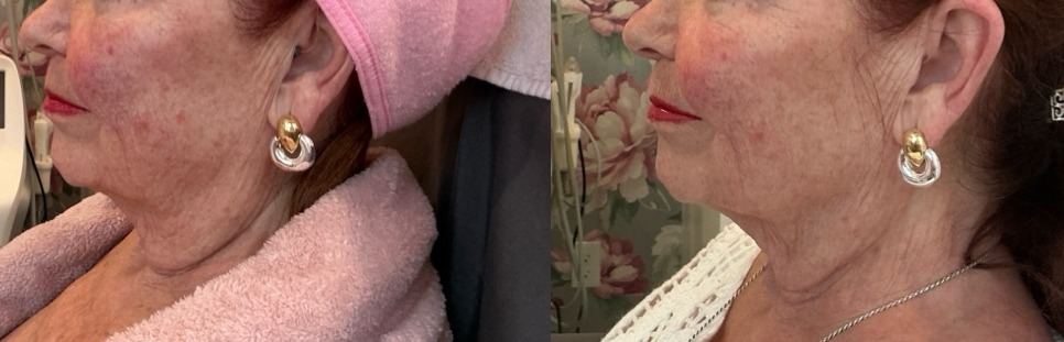 Sofwave Treatment Before & After Image