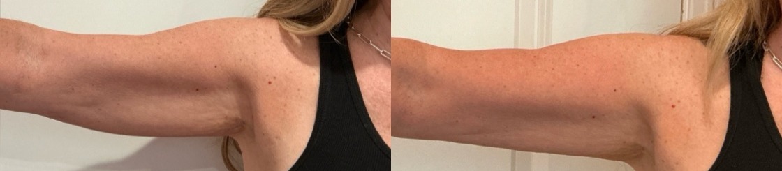 Sofwave Treatment Before & After Image
