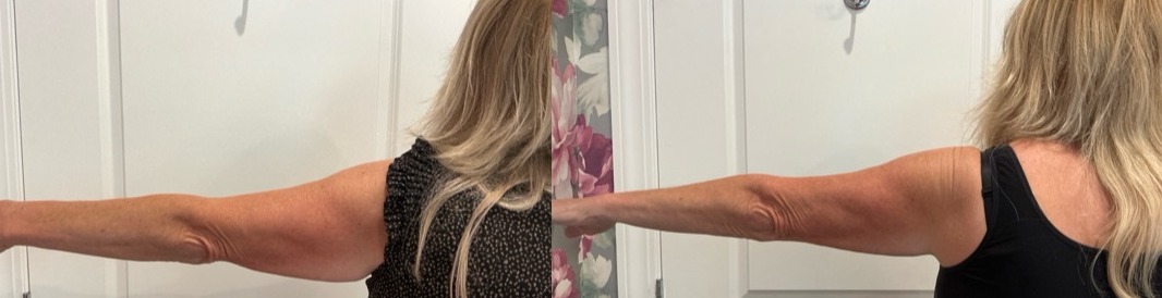 Sofwave Treatment Before & After Image