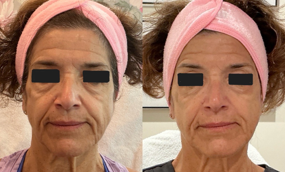 Sofwave Treatment Before & After Image
