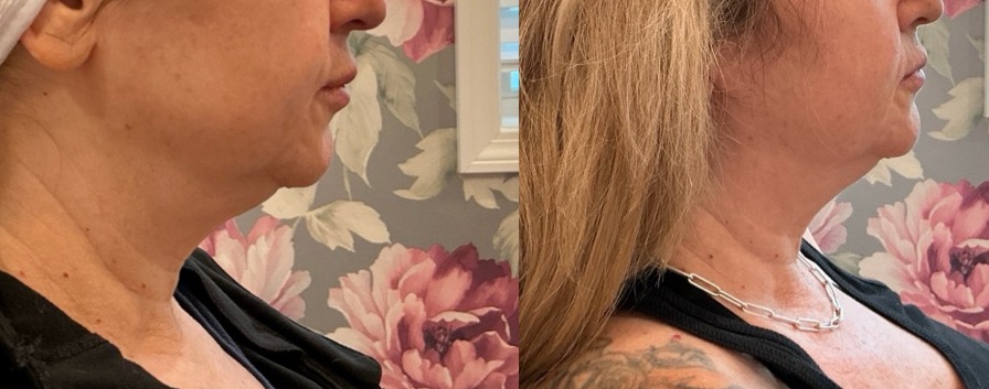 Sofwave Treatment Before & After Image