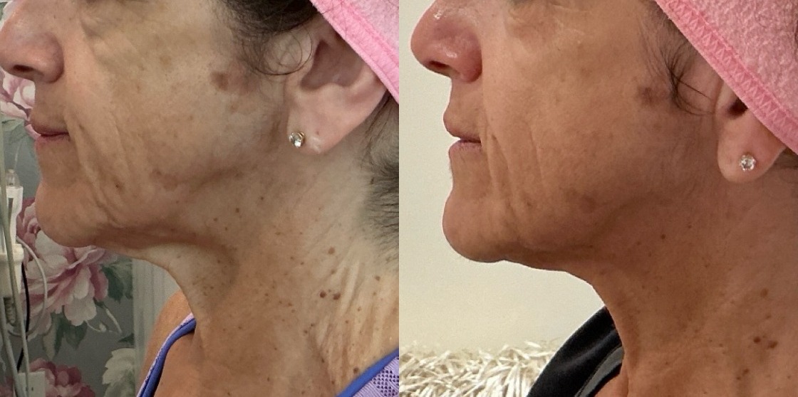 Sofwave Treatment Before & After Image