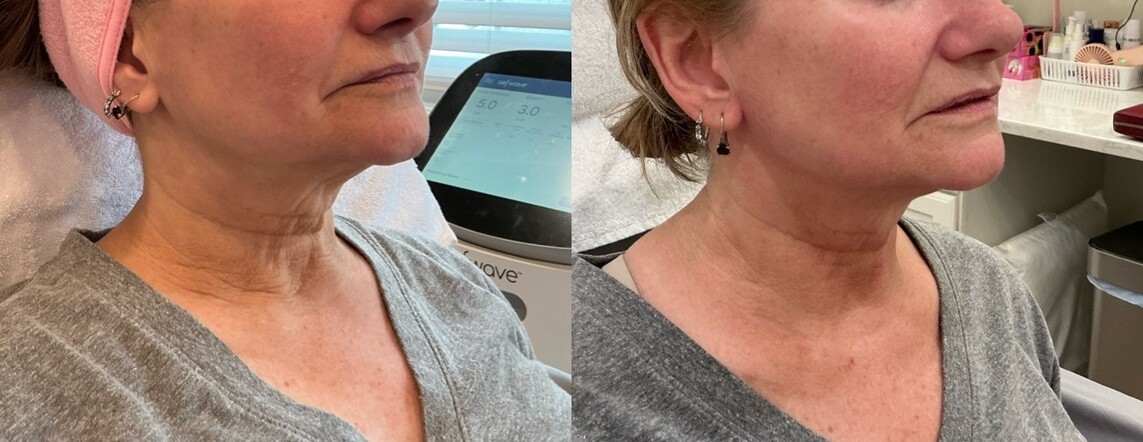 Sofwave Treatment Before & After Image