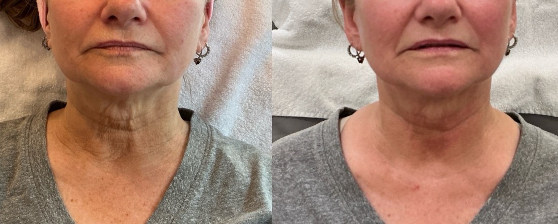 Sofwave Treatment Before & After Image