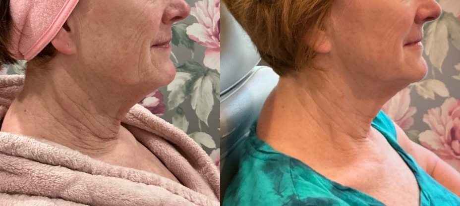 Sofwave Treatment Before & After Image