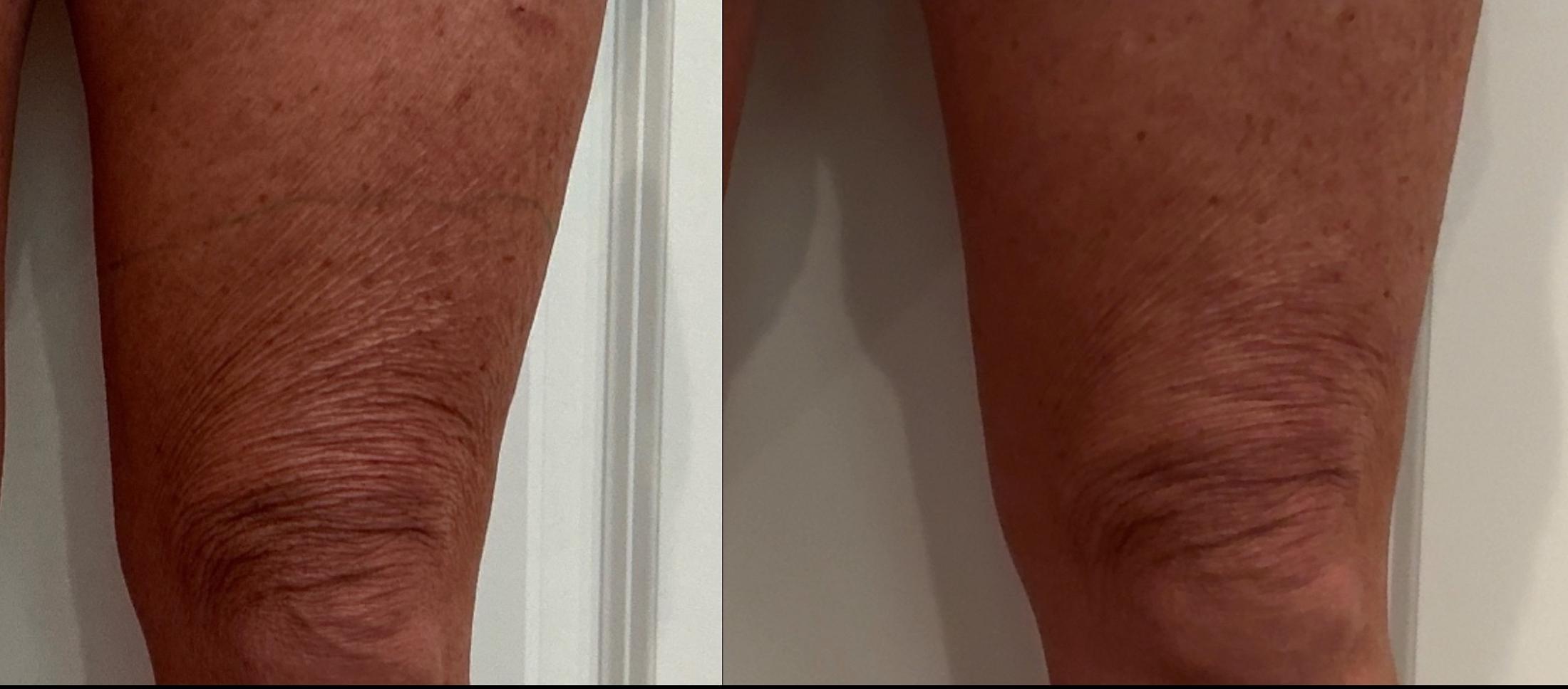 Sofwave Treatment Before & After Image