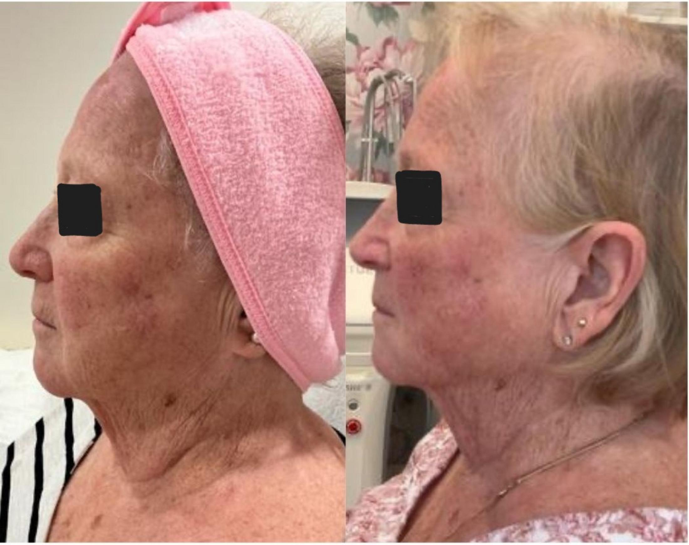 Sofwave Treatment Before & After Image
