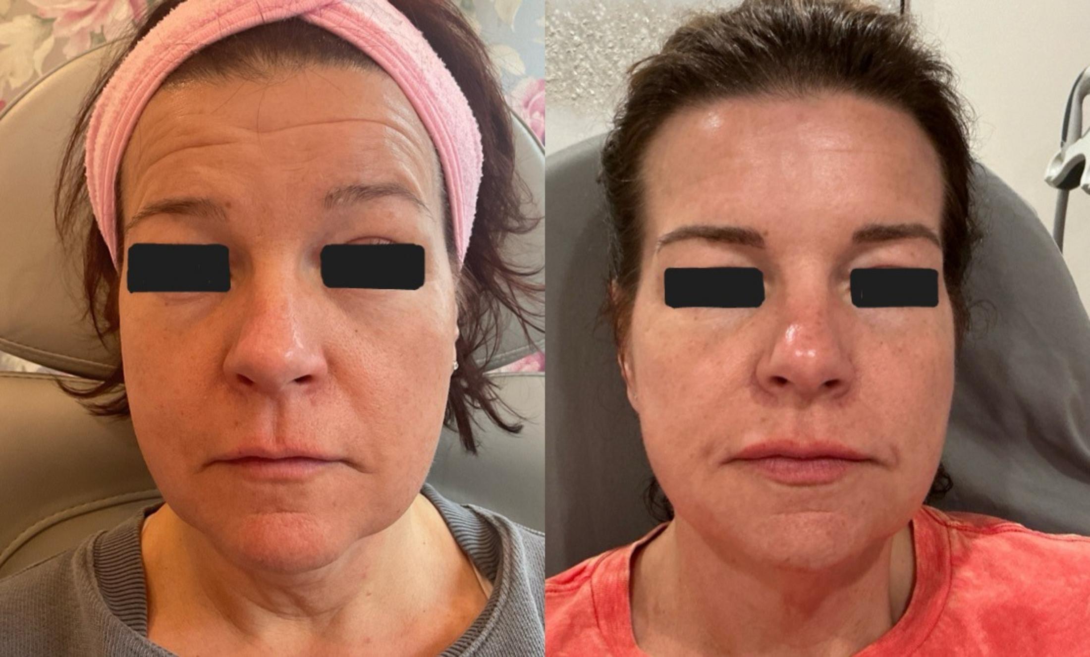 Sofwave Treatment Before & After Image