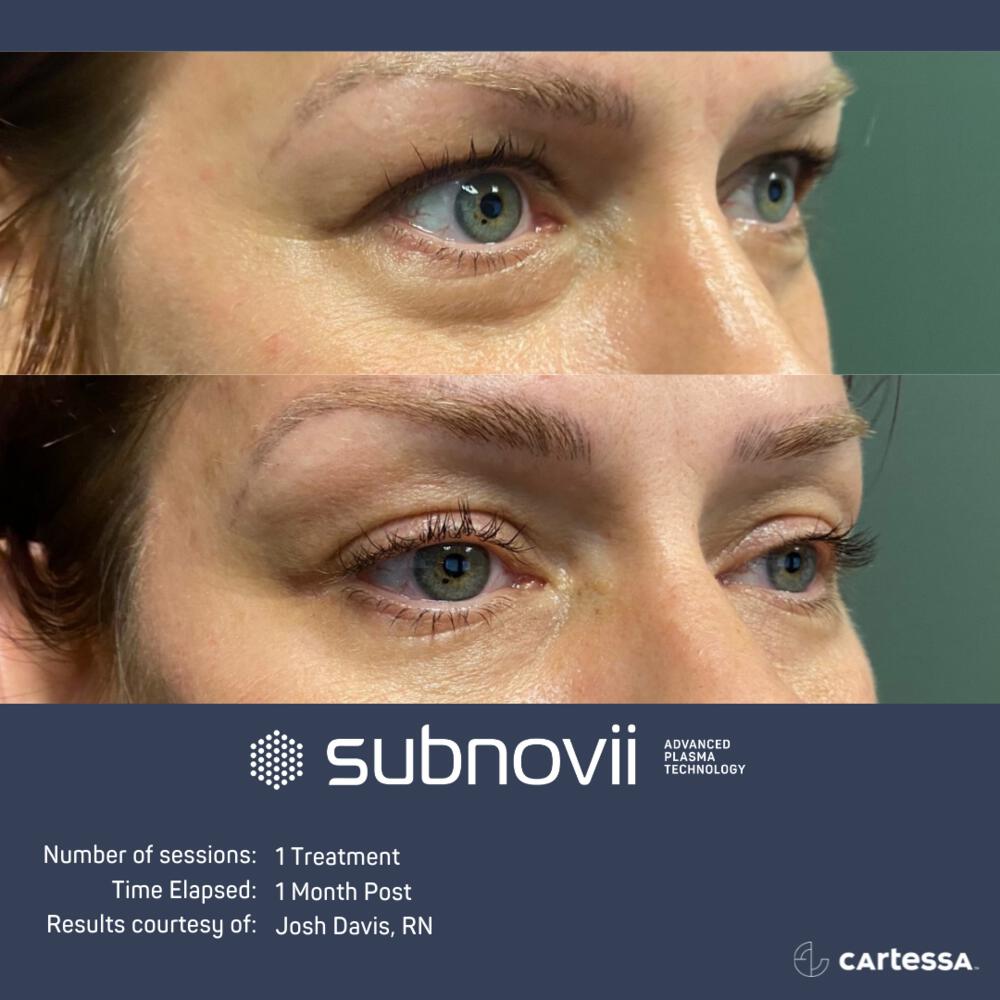 Subnovii Before & After Image