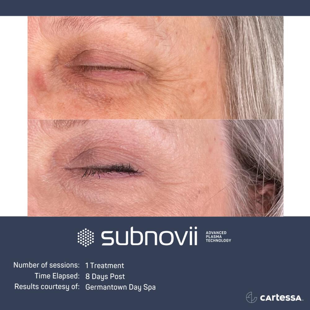 Subnovii Before & After Image