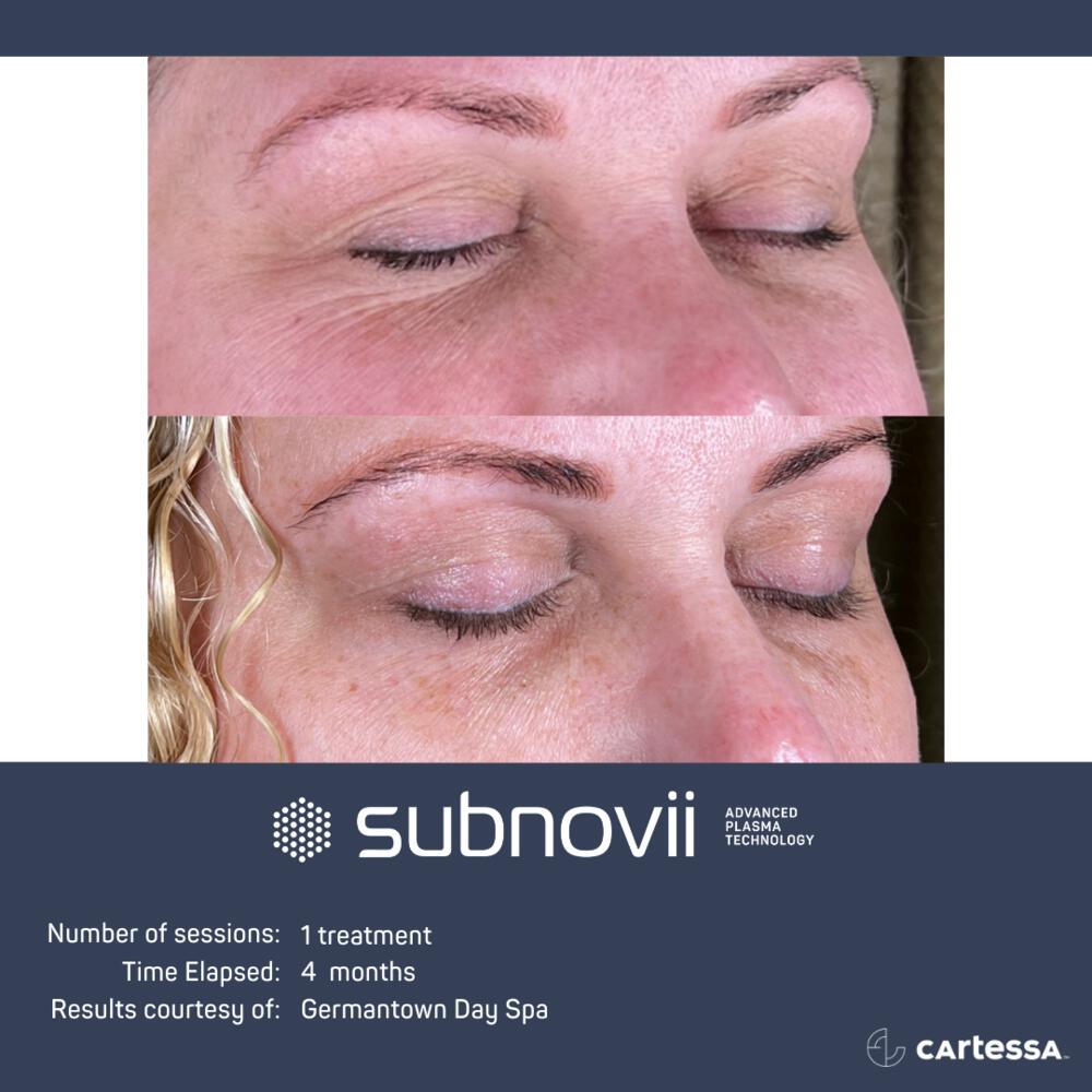 Subnovii Before & After Image