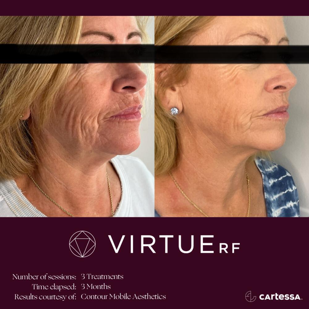 Virtue RF Microneedling Before & After Image