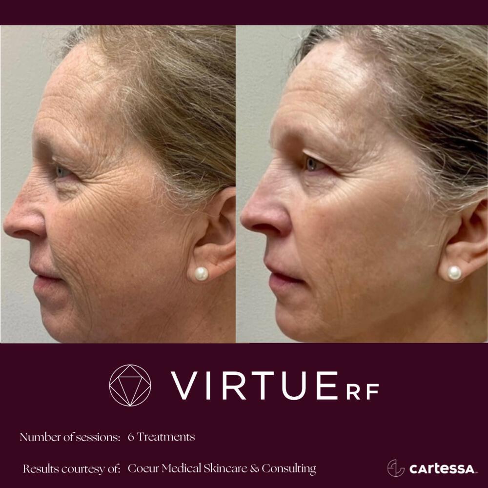 Virtue RF Microneedling Before & After Image