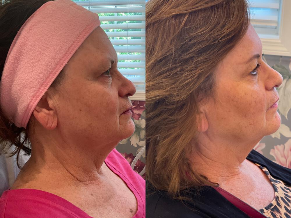 Virtue RF Microneedling Before & After Image