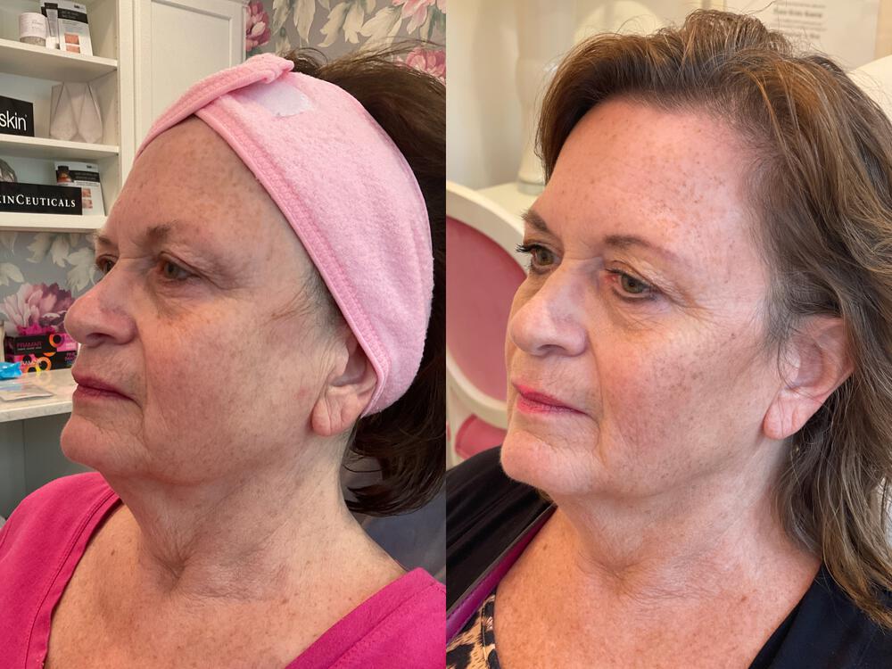 Virtue RF Microneedling Before & After Image