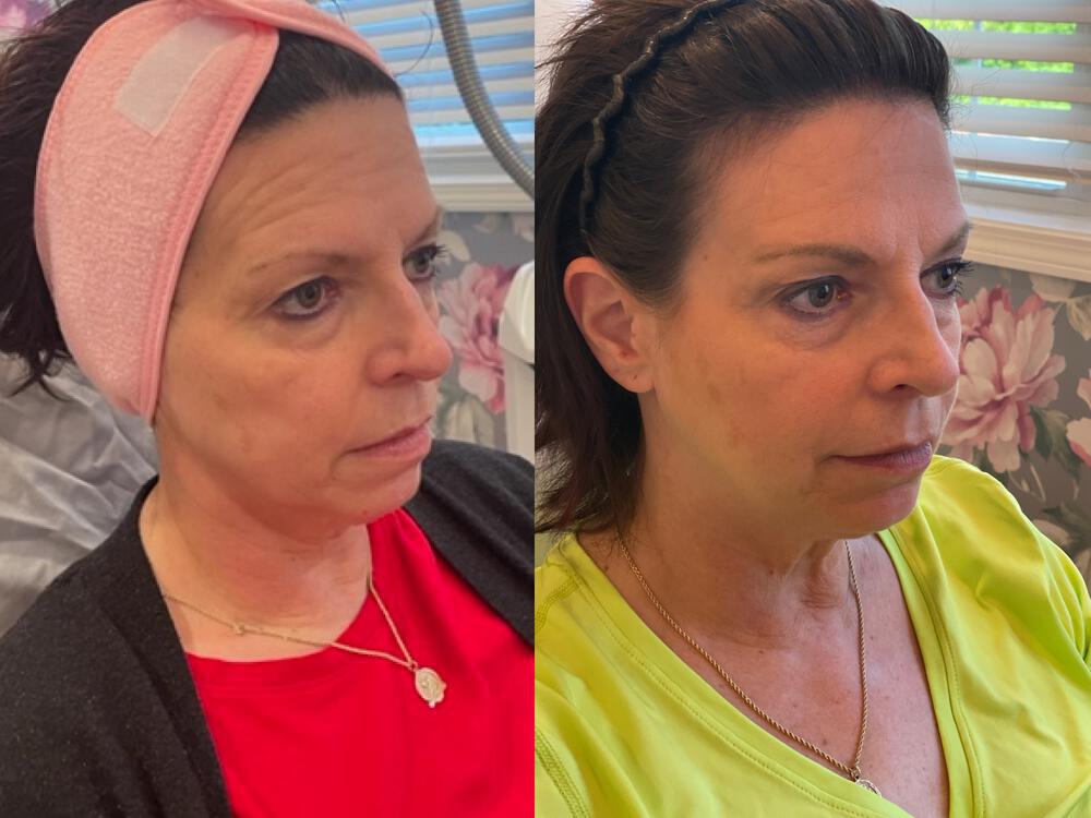 Virtue RF Microneedling Before & After Image