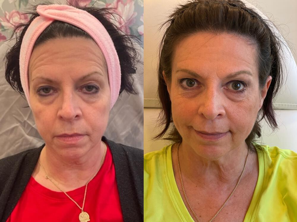 Virtue RF Microneedling Before & After Image