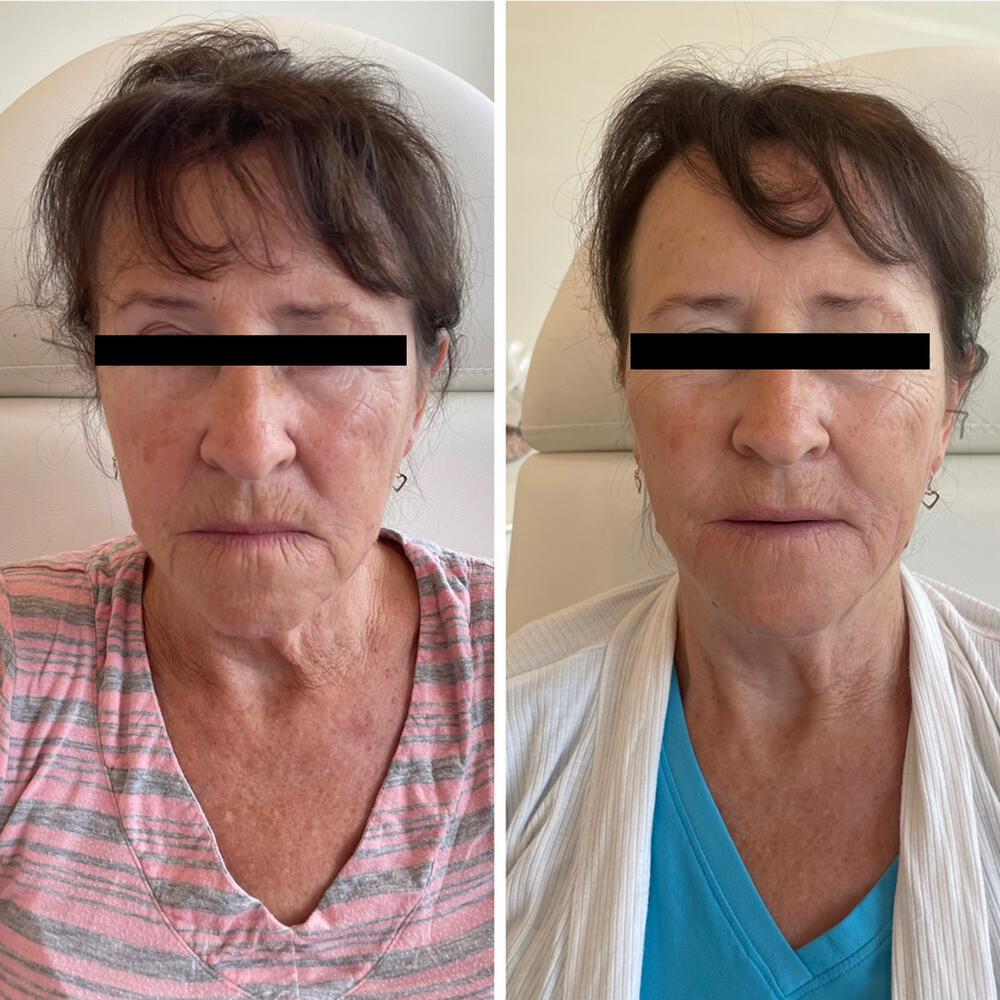 Virtue RF Microneedling Before & After Image