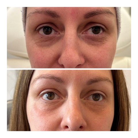 Virtue RF Microneedling Before & After Image