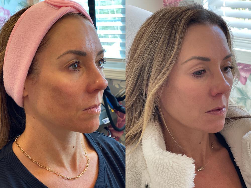Medical Peels Before & After Image