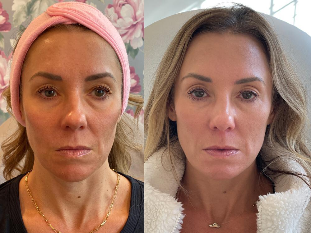Medical Peels Before & After Image