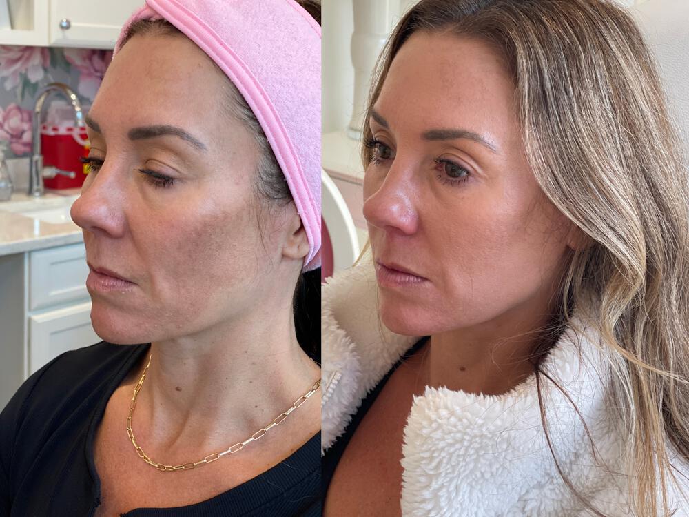 Medical Peels Before & After Image