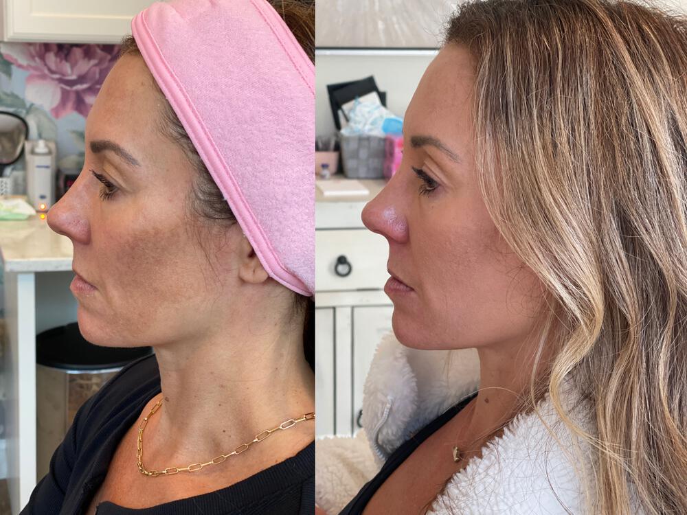 Medical Peels Before & After Image